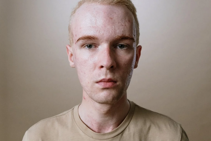acne prone